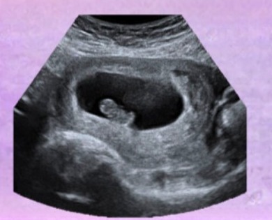 Black and white early pregnancy ultrasound from BabyLoading