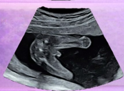 Black and white gender-session ultrasound from BabyLoading